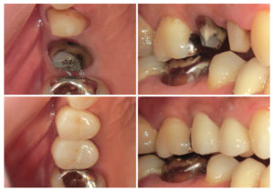 ジルコニアクラウン