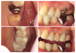 ジルコニアクラウン