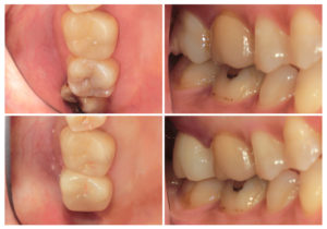 ジルコニアクラウン