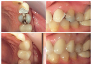 レアリングタイプのクラウン・ジルコニアクラウン