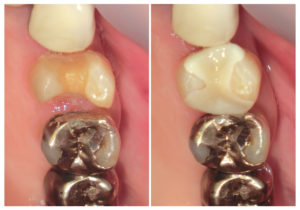 ジルコニアインレー