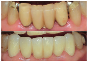 ジルコニアクラウンのブリッジ