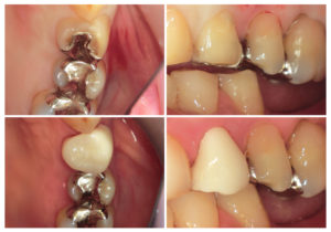 ジルコニアクラウン