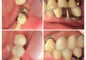 ジルコニアクラウン