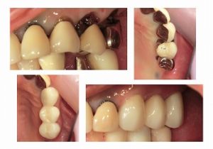 ジルコニアクラウン