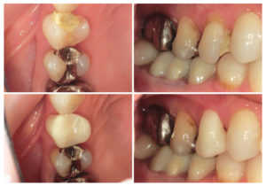 ジルコニアクラウン