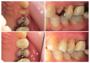 ジルコニアクラウン