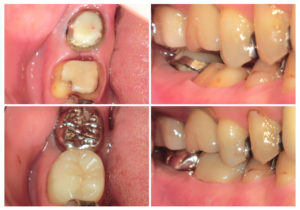 ジルコニアクラウン