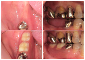 ノンクラスプデンチャー