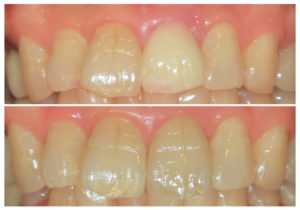 レアリングタイプのクラウン