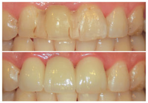 レアリングタイプのブリッジ