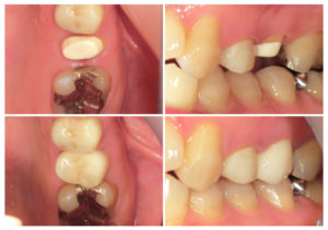 ジルコニアクラウン