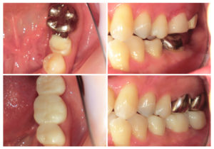 ジルコニア延長ブリッジ