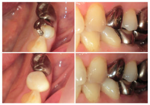 ジルコニアクラウン