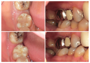 ジルコニアインレー