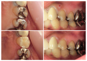 ジルコニアインレー