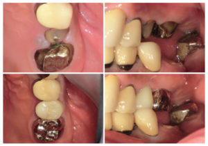 ジルコニアクラウン