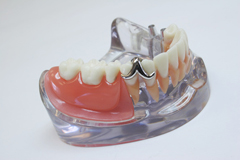 1.保険の入れ歯と自費の入れ歯の違いって？