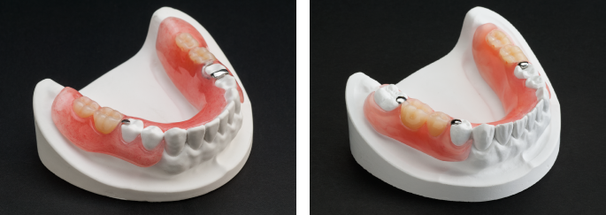 ノンクラスプデンチャーって？ – 大阪天満橋岡本歯科医院