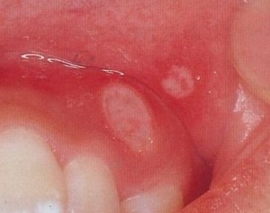 口内炎の原因と予防