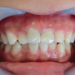 オールセラミックによる前歯2本の審美矯正