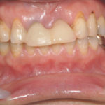 前歯全体をセラミックで治療