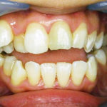 折れた歯をオールセラミックで