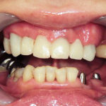 ジルコニアでブリッジ作成