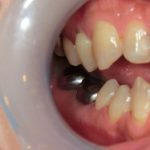 まるまるジルコニアクラウンの症例