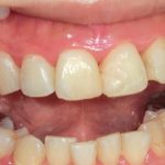 前歯３本の見た目を修復した症例