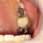 審美性を考えたジルコニアモノコッククラウン