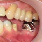 銀色のブリッジをジルコニアで自然に