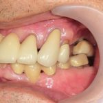インプラントによる欠損の治療