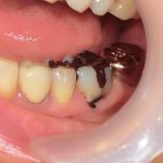 ジルコニアモノコックのクラウンで修復