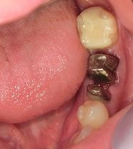 より割れにくくキレイな歯に