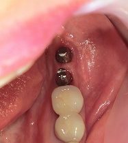 インプラントの被せ物