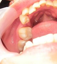 1本の欠損をジルコニアブリッジで修復