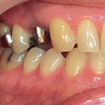 白く割れにくいジルコニアモノコッククラウン