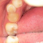 ジルコニアクラウンによる奥歯の治療