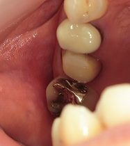 銀歯が外れた部分をジルコニアモノコッククラウンで2