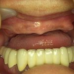 インプラント＋ブリッジでの治療