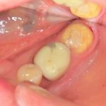 割れにくいセラミック