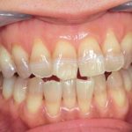 歯の色の悩みを改善