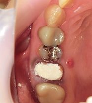 根管治療後にジルコニアモノコッククラウンで修復