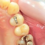 ジルコニアインレーで治療