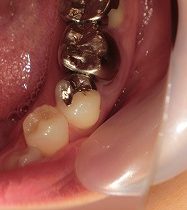 左下奥をジルコニアで治療
