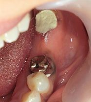 ジルコニアフレームのセラミックブリッジ