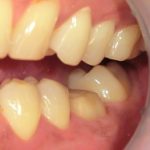 銀歯で治療していた部分をジルコニアに。