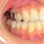 ジルコニアで白い歯に作り変える。