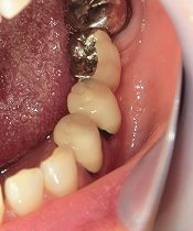 ジルコニアモノコックのブリッジ